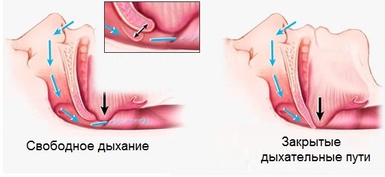 Избавиться от храпа хирургическим путем