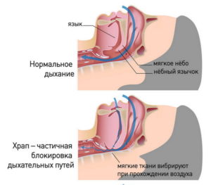 Причины мужского храпа