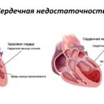 Сердечная недостаточность