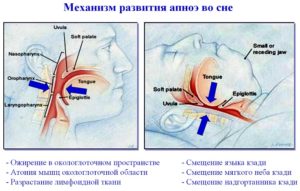 Синдромом апноэ