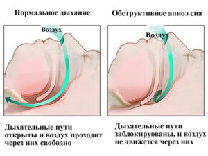 Синдромом обструктивного апноэ сна