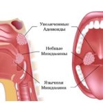 Аденоиды
