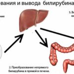 Гипербилирубинемия