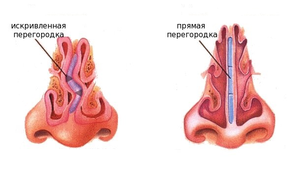 Искривление носовой перегородки