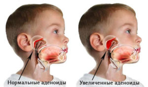 Иссечения аденоидов