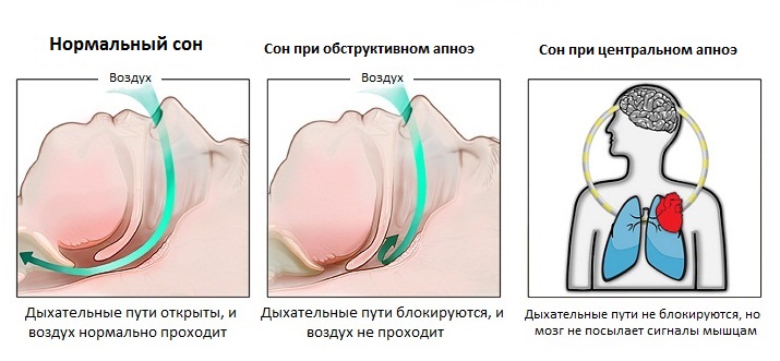 Классификация апноэ