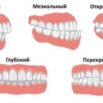 Неправильный прикус