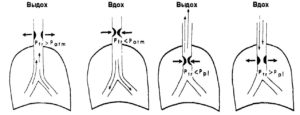 Падение внутригрудного давления