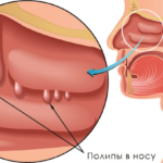 Полипы в носу