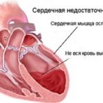 Сердечная недостаточность