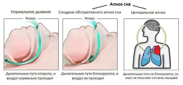 ЦЕНТРАЛЬНОЕ АПНОЭ СНА