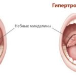 Увеличение размеров миндалин