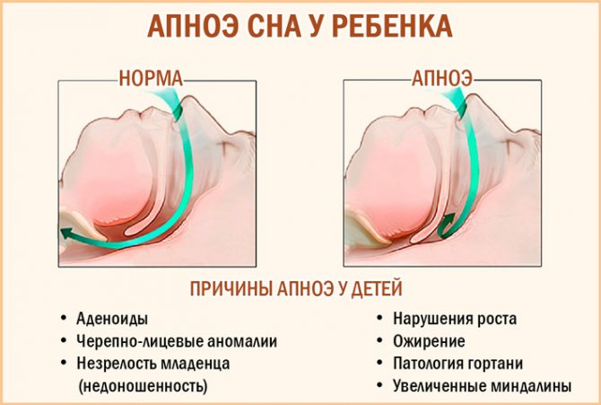 Аденоиды и храп у ребенка: симптомы, опасность патологии, методы лечения